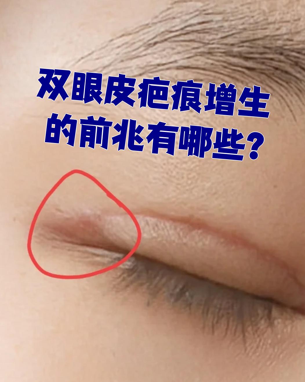 双眼皮疤痕增生的前兆通常有疼痛,瘙痒,质地发硬等表现