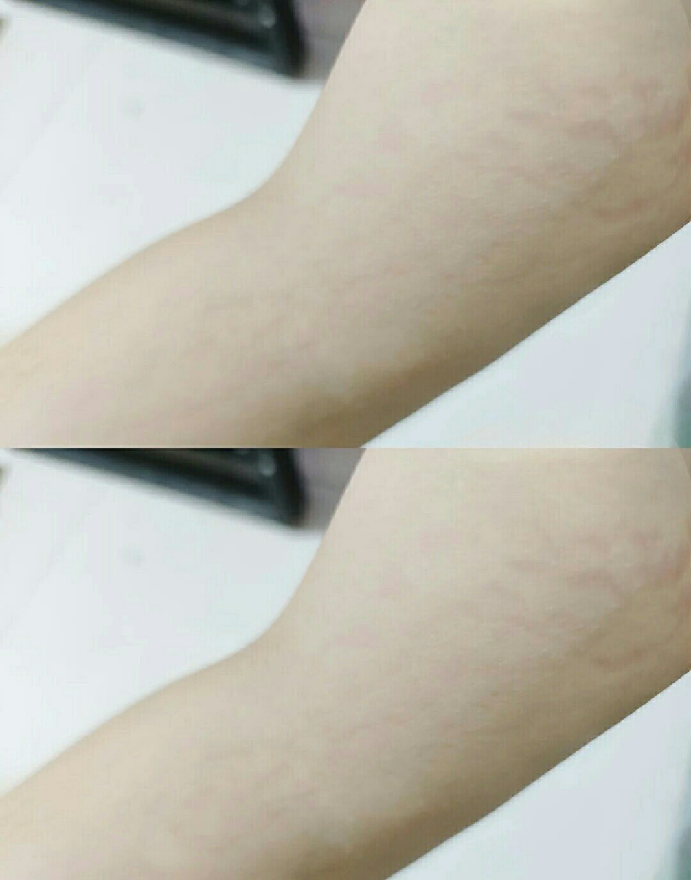 我胳膊上长肥胖纹啦!这东西我知道的晚了!