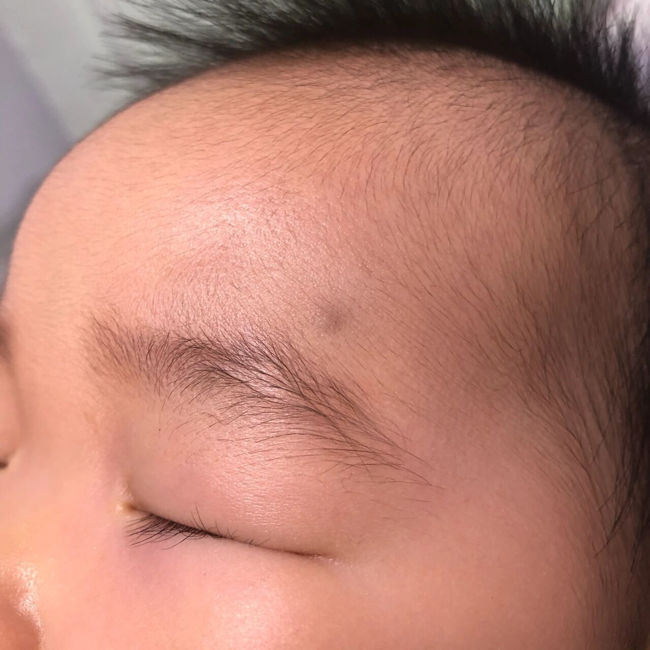 宝宝皮脂腺囊肿有明白的来探讨下 宝宝四个多月的时候偶然发现眉毛