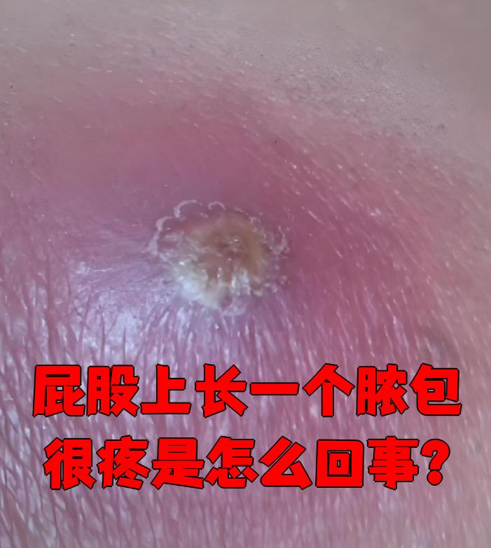 皮脂腺囊肿是因为皮脂腺的油脂排不出来,堵在皮肤里形成的包