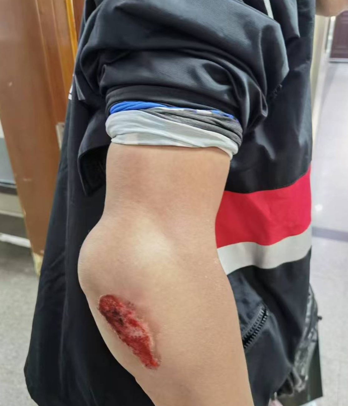 摔倒后手臂抬不起来,使不上劲,可能是软组织损伤,关节脱位或骨裂等