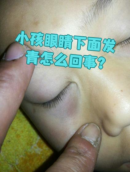 孩子眼睛下面发青,常见原因有外伤性淤血,睡眠不足和用眼过度