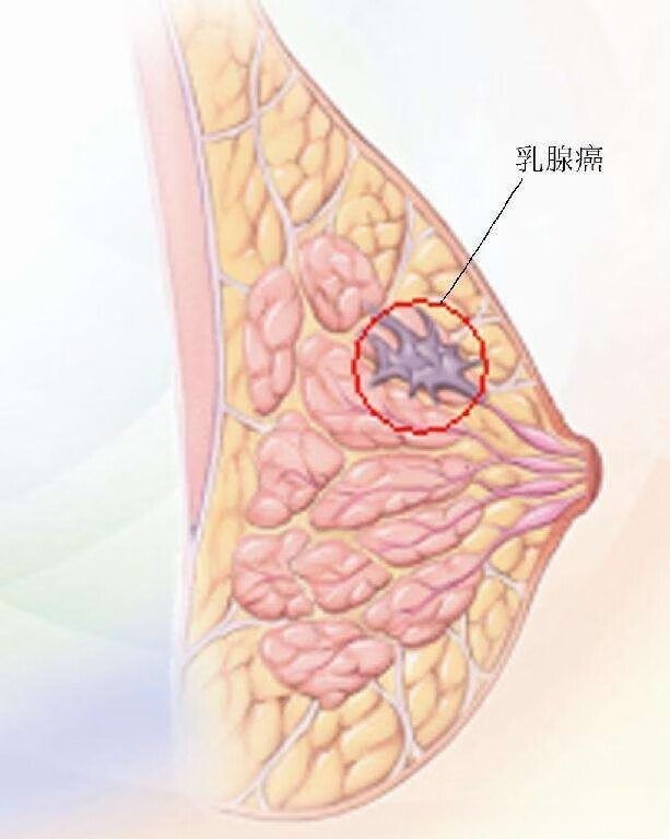 乳腺肿瘤早期症状图片