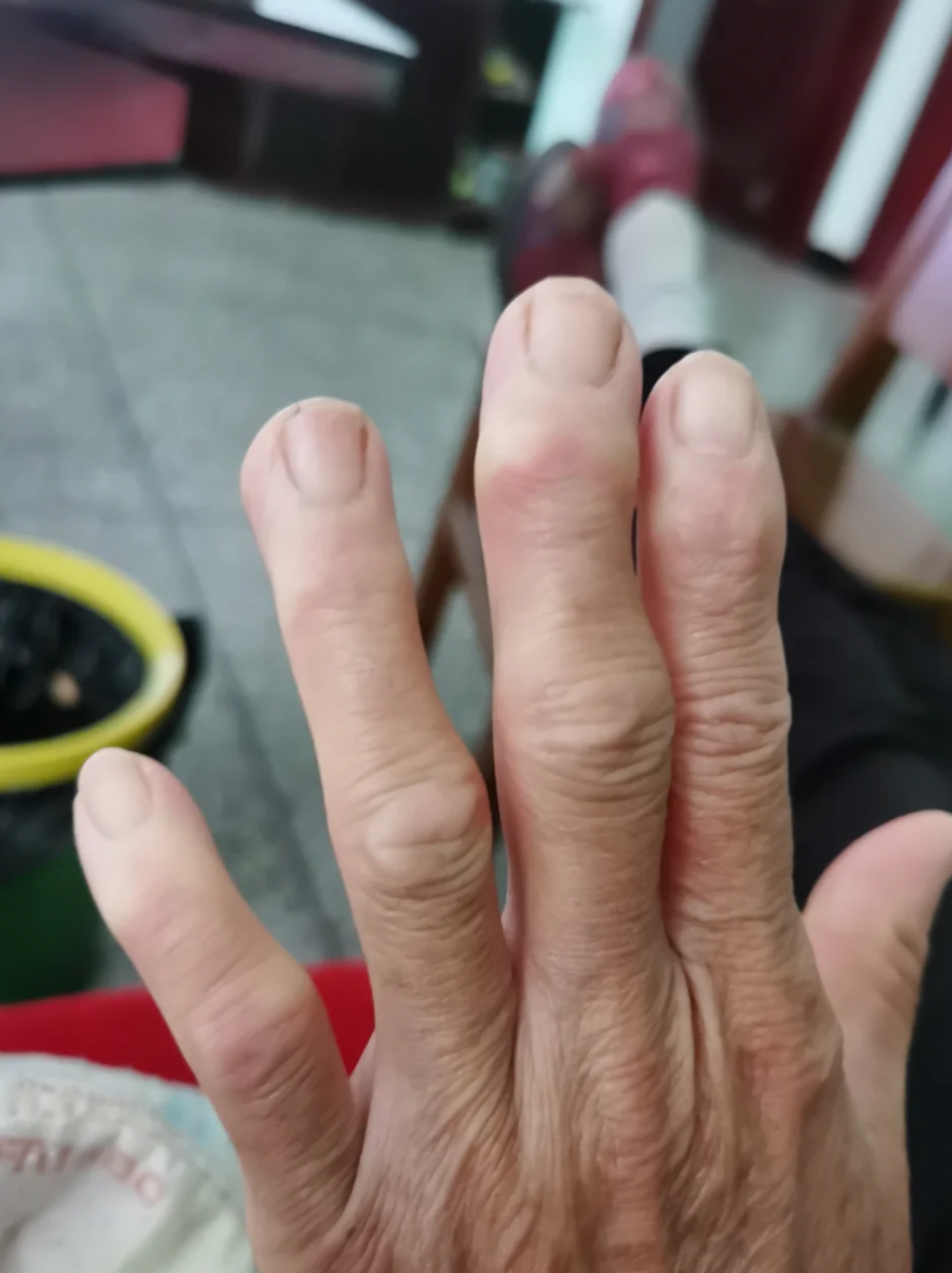 老年人手指关节肿大变形最常见的原因是三种疾病:指间关节骨关节炎