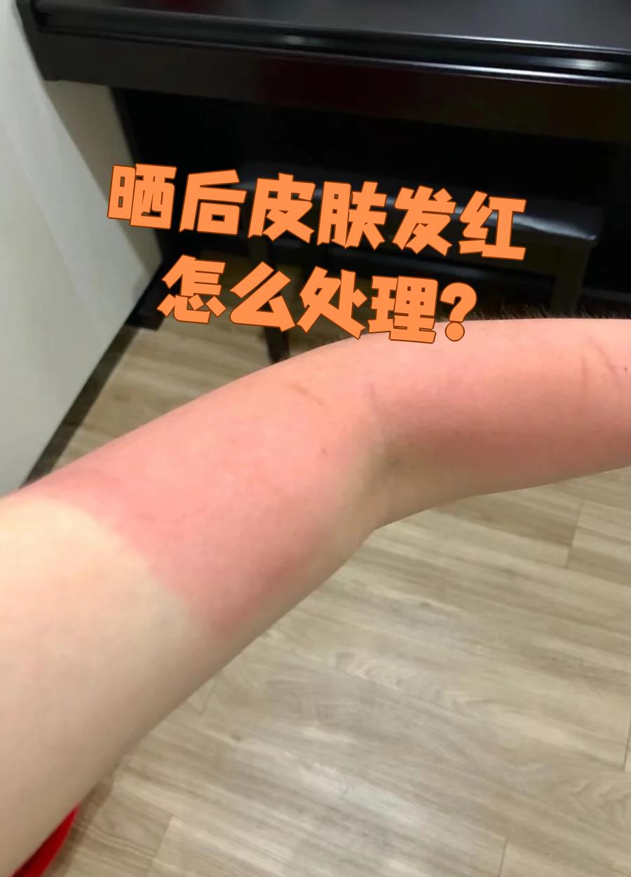 晒后皮肤发红是日晒伤的常见表现,主要因为紫外线让皮肤细胞里的