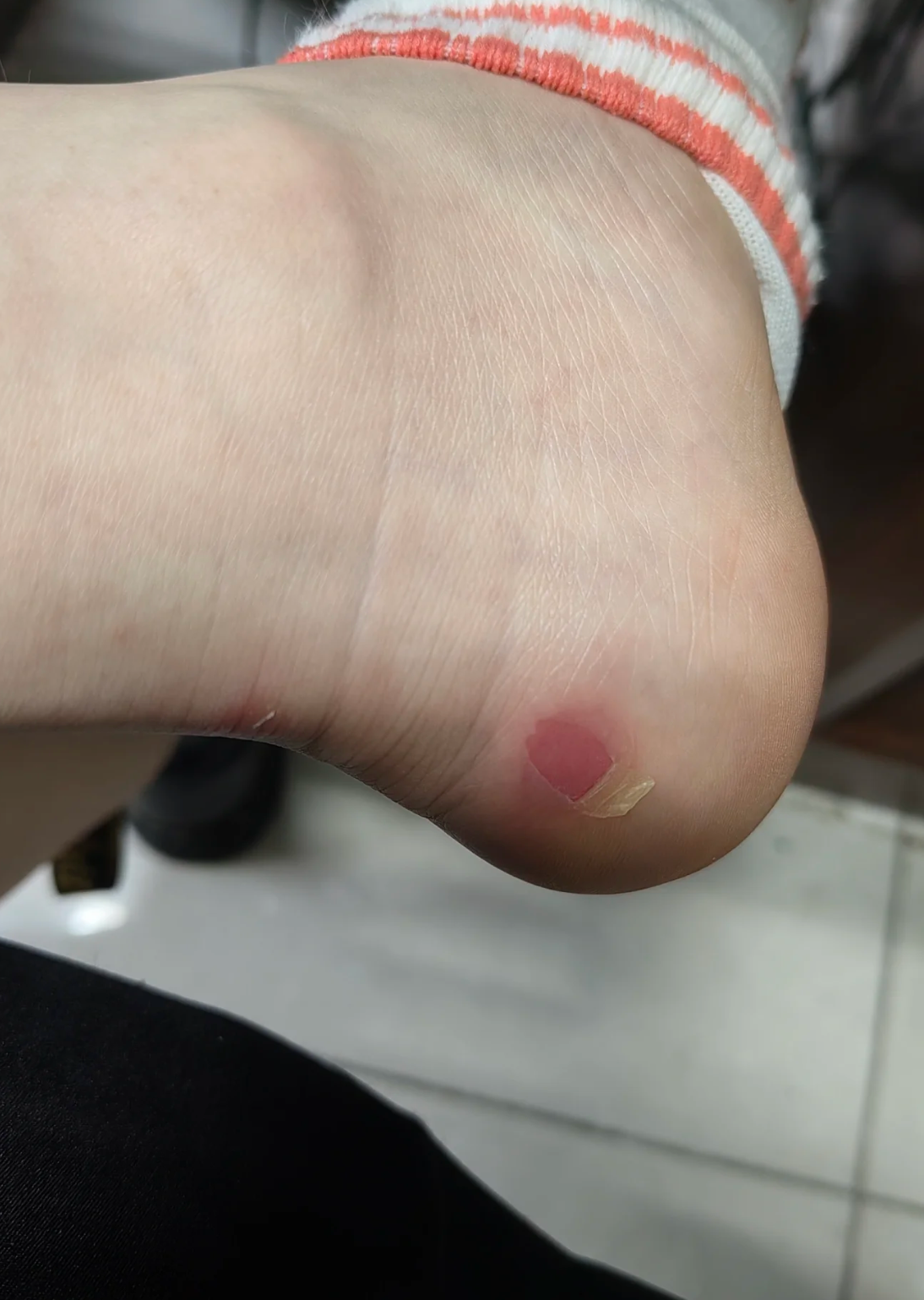 脚后跟酸痛常见的原因有四个:运动过量,外伤,骨刺和筋膜炎