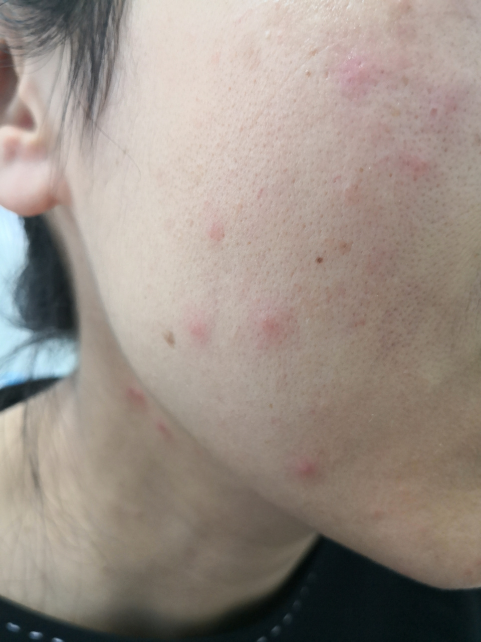 考虑面部用品过敏导致的接触性皮炎症状,急性期症状.