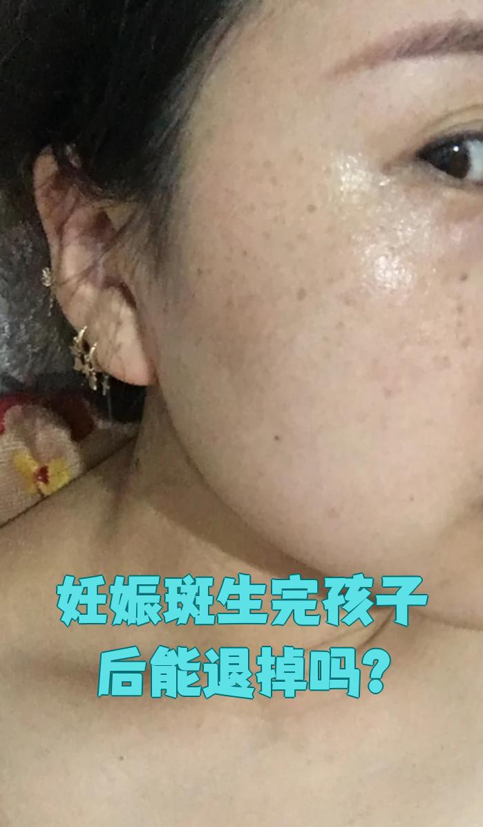 怀孕时体内激素变化大,尤其是孕激素会刺激黑色素细胞产生更多黑