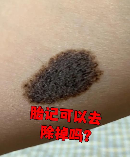 蒙古斑为什么叫蒙古斑