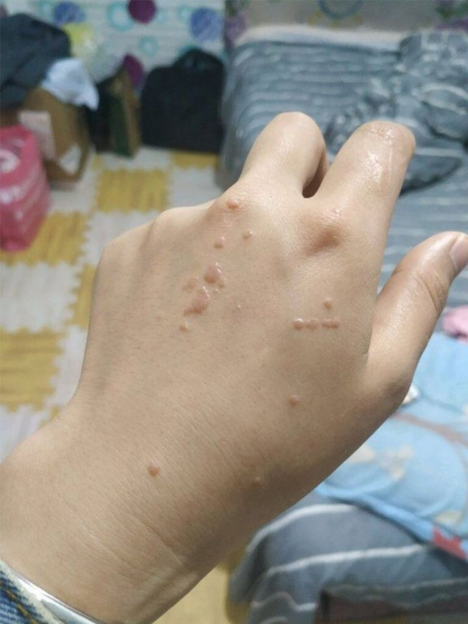 扁平疣从上大学起一直跟随着我,一开始是手背上,后面手臂上也长过