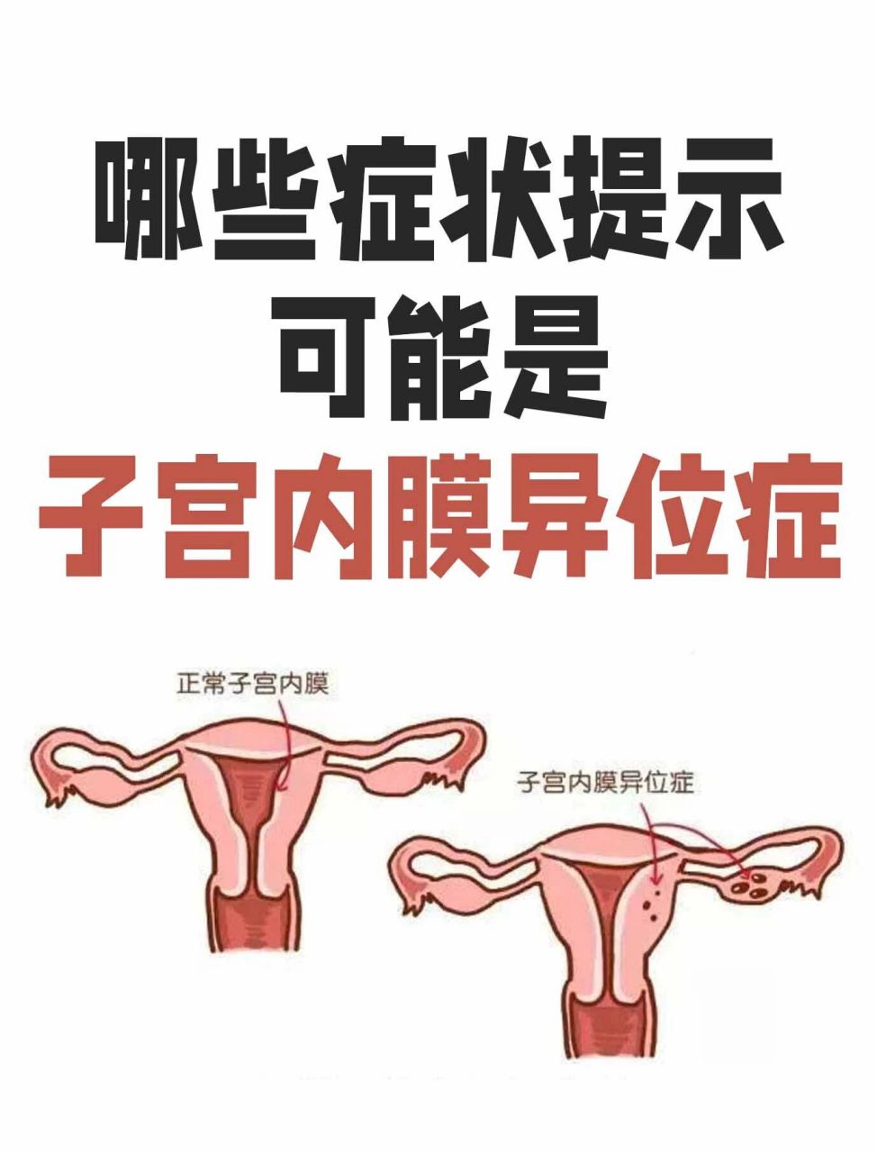 71 子宫内膜异位症的主要症状是盆腔痛,通常与月经期有关.