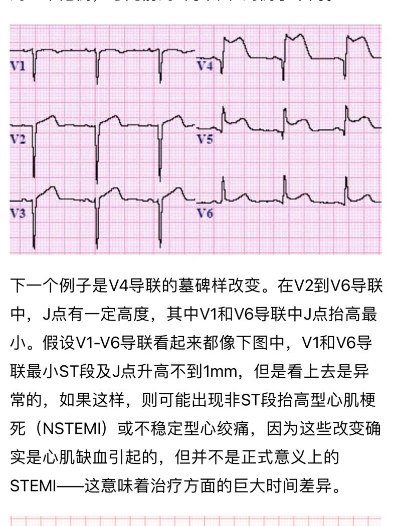 各壁心梗对应心电图图片