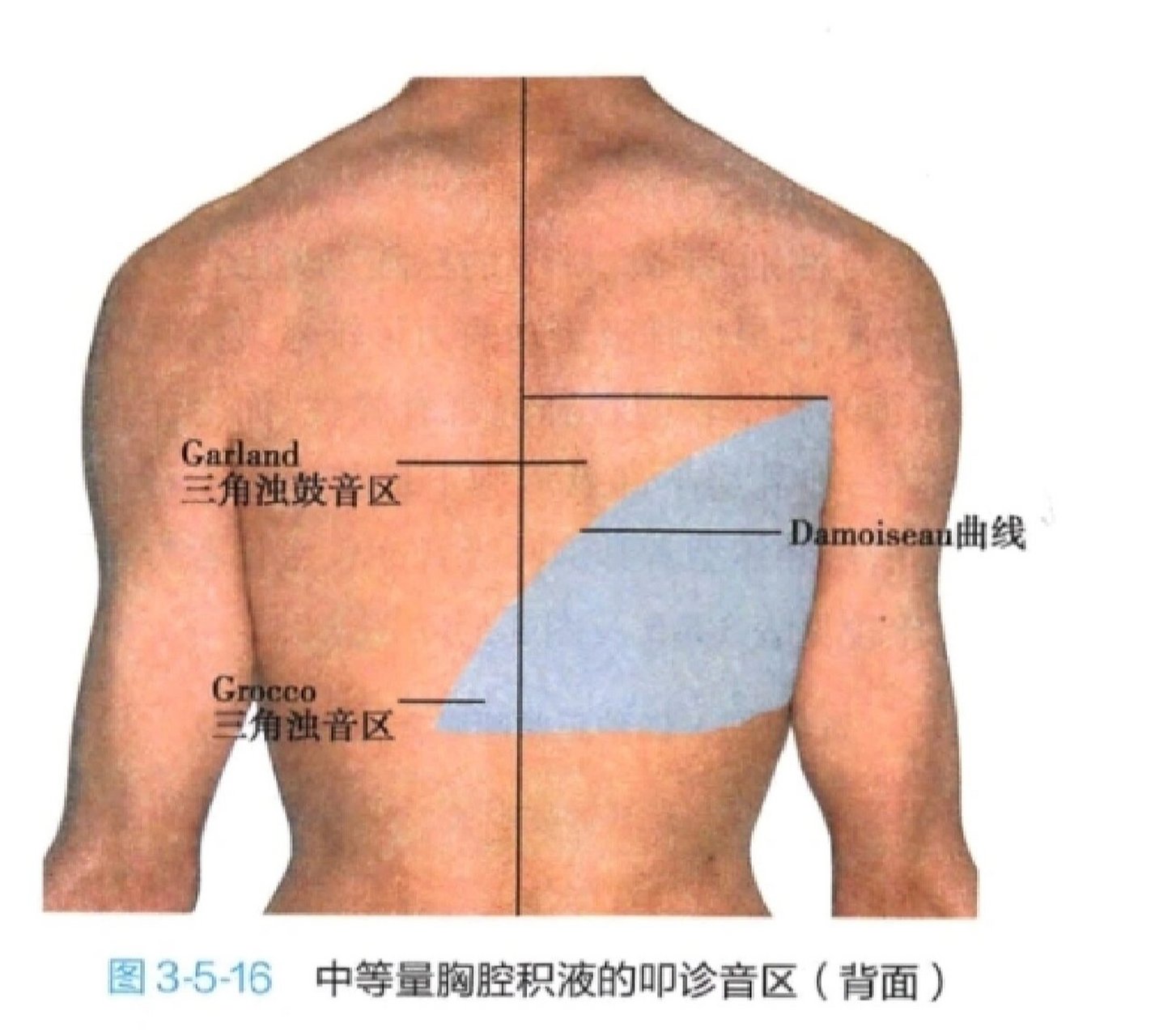 肺上界叩诊图片