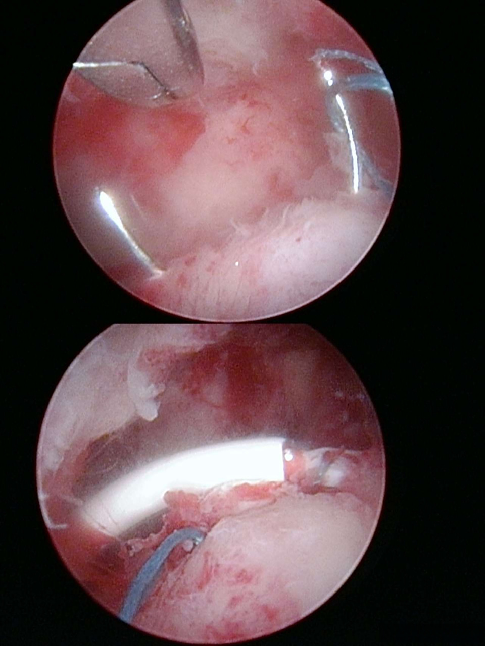 曼月乐环对于子宫腺肌症,子宫内膜异位症,子宫内膜增生或月经过多都是