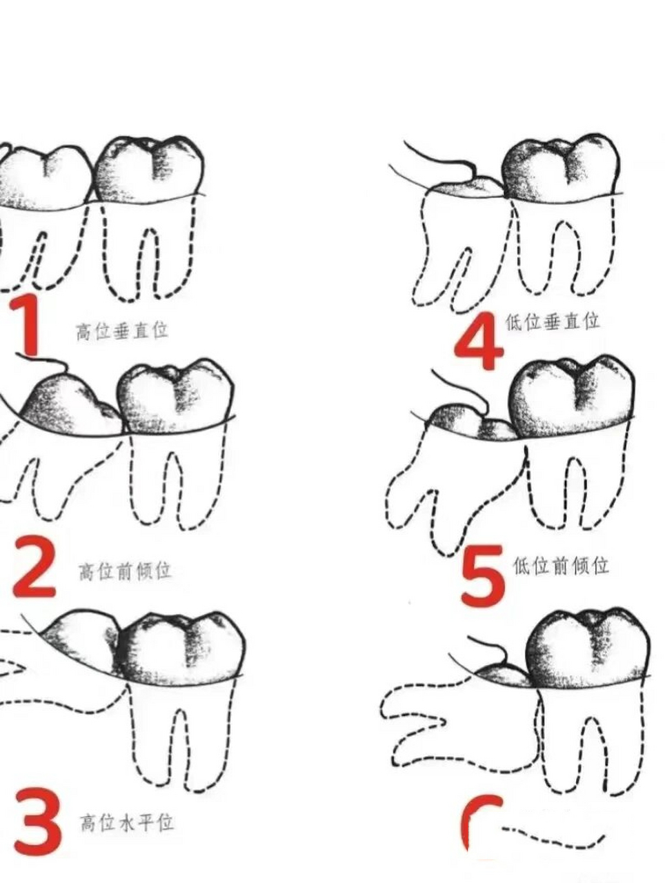 拔阻生智齿,正规医院的价格参考 阻生智齿拔除补上上一篇玉林市第三