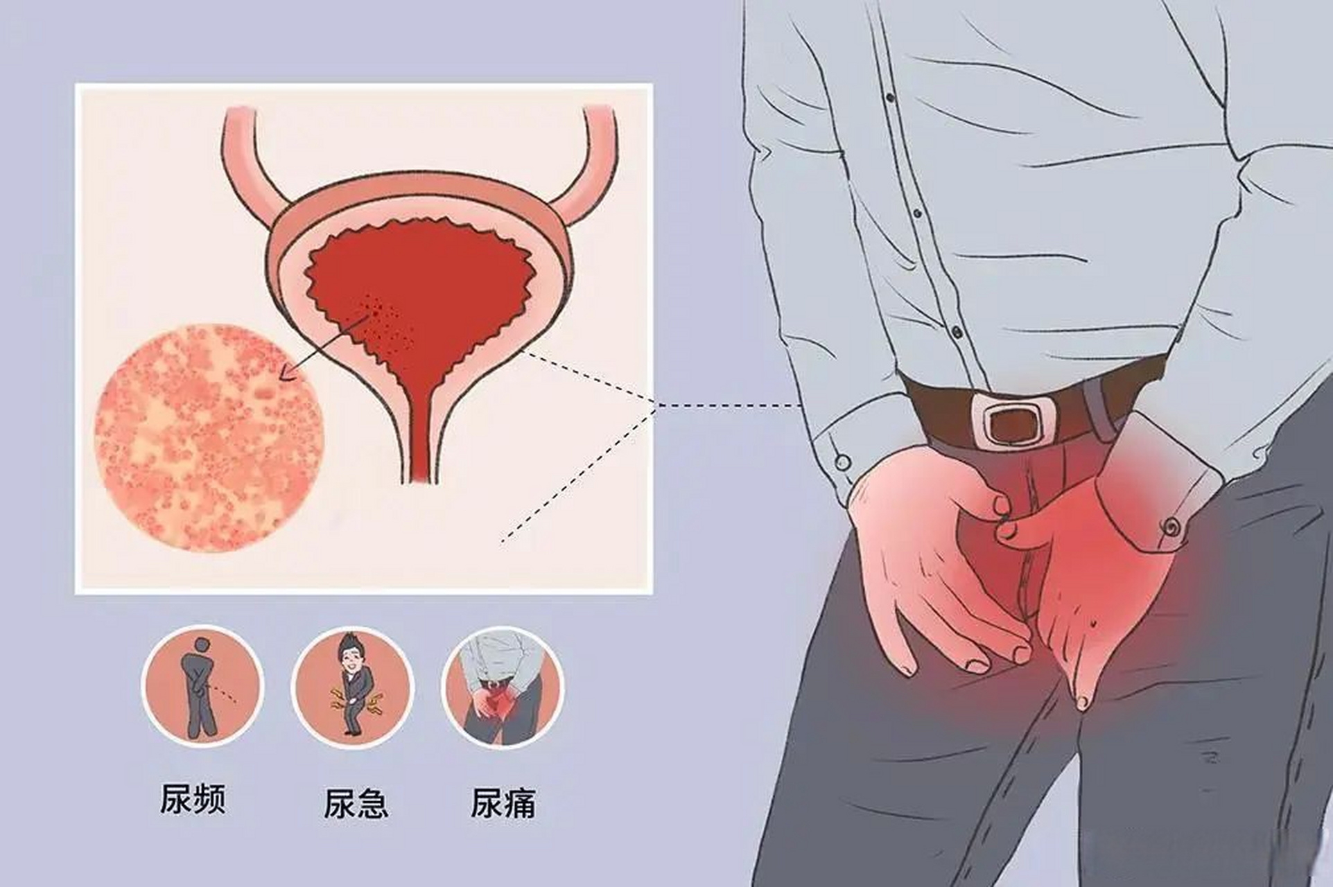 尿道炎是目前男科及泌尿外科门诊常见的疾病之一,它是指尿道由于不