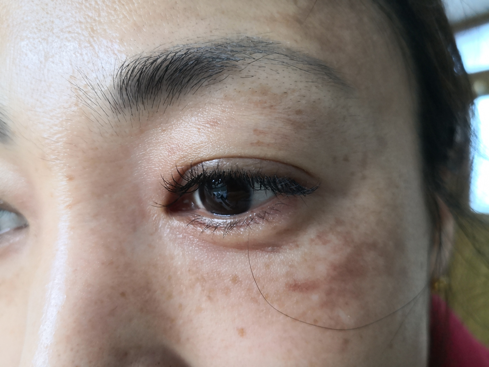 考虑黄褐斑症状黄褐斑 需要系统治疗一段时间能够达到比较好的美容