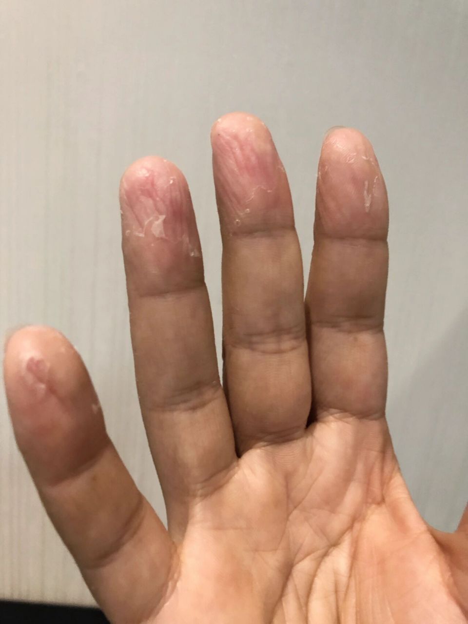 手指贫血图片图片