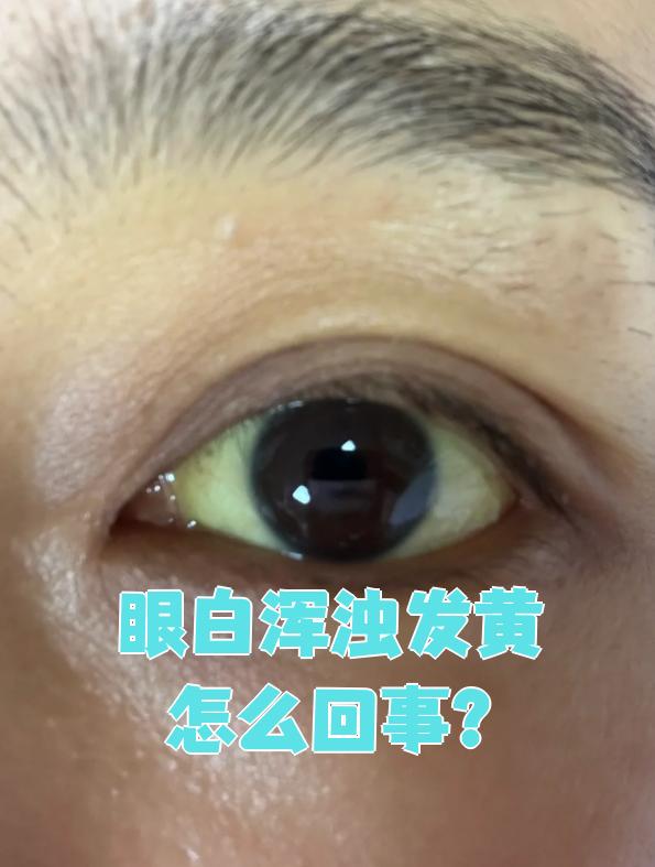 眼白浑浊发黄最常见的原因是肝胆疾病和结膜色素沉着