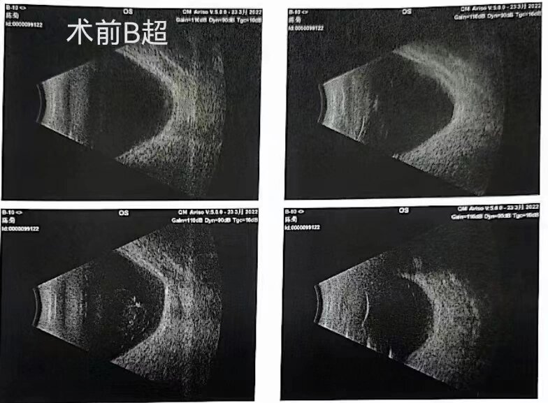 玻璃体混浊weiss环图片图片