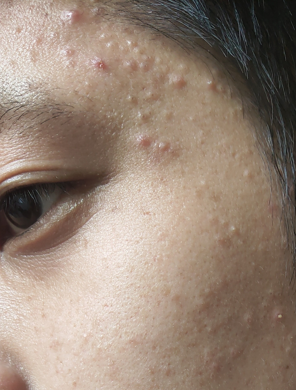 选对方法坚持治疗非常重要#痤疮