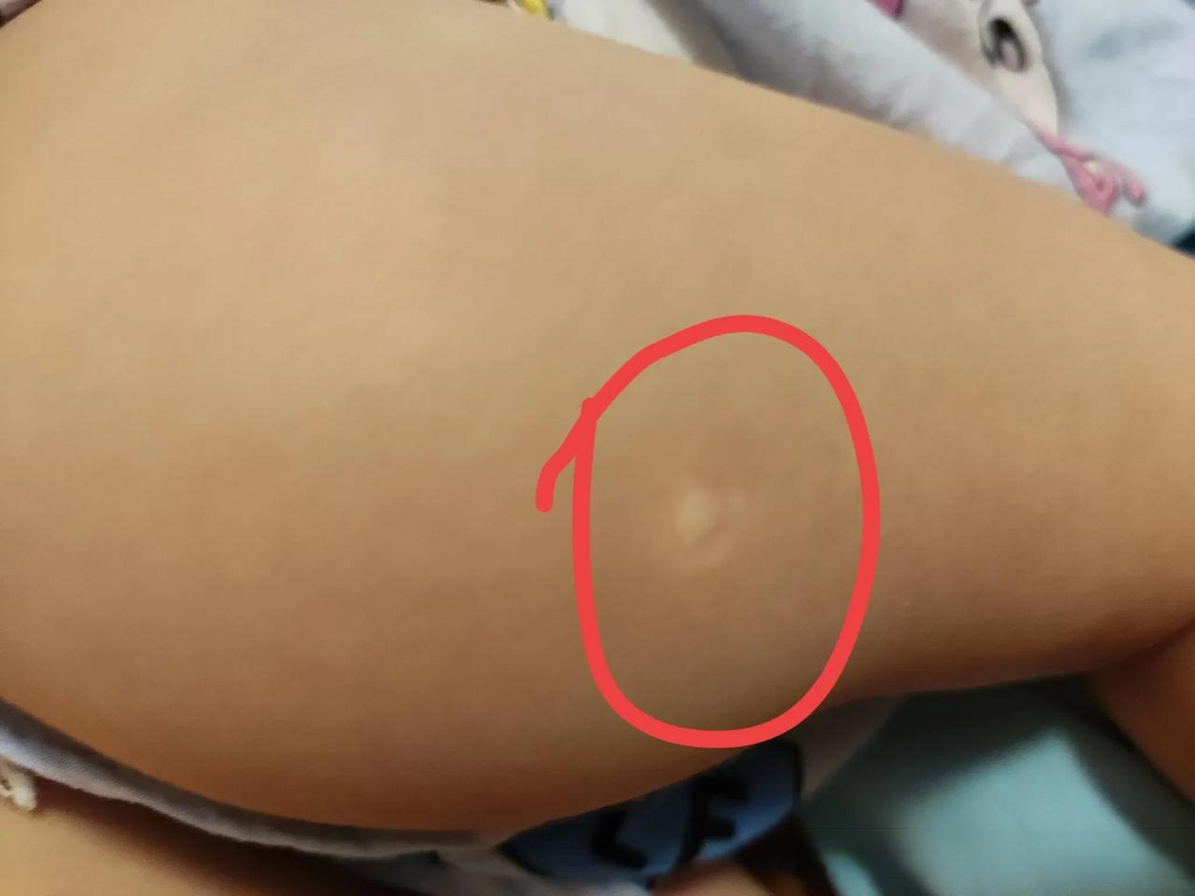 我们小时候注射疫苗胳膊上会有个疤,怎么这么多年过去了还是会有疤?