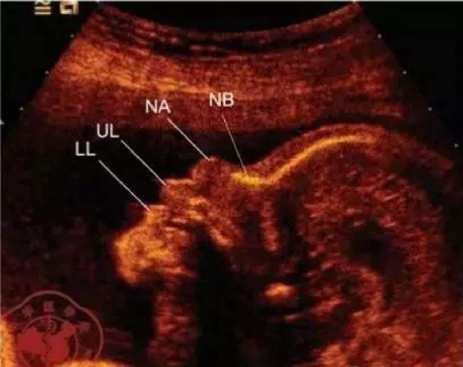 鼻骨缺失或短小的注意事项 国人正常胎儿鼻骨发育情况的研究显示