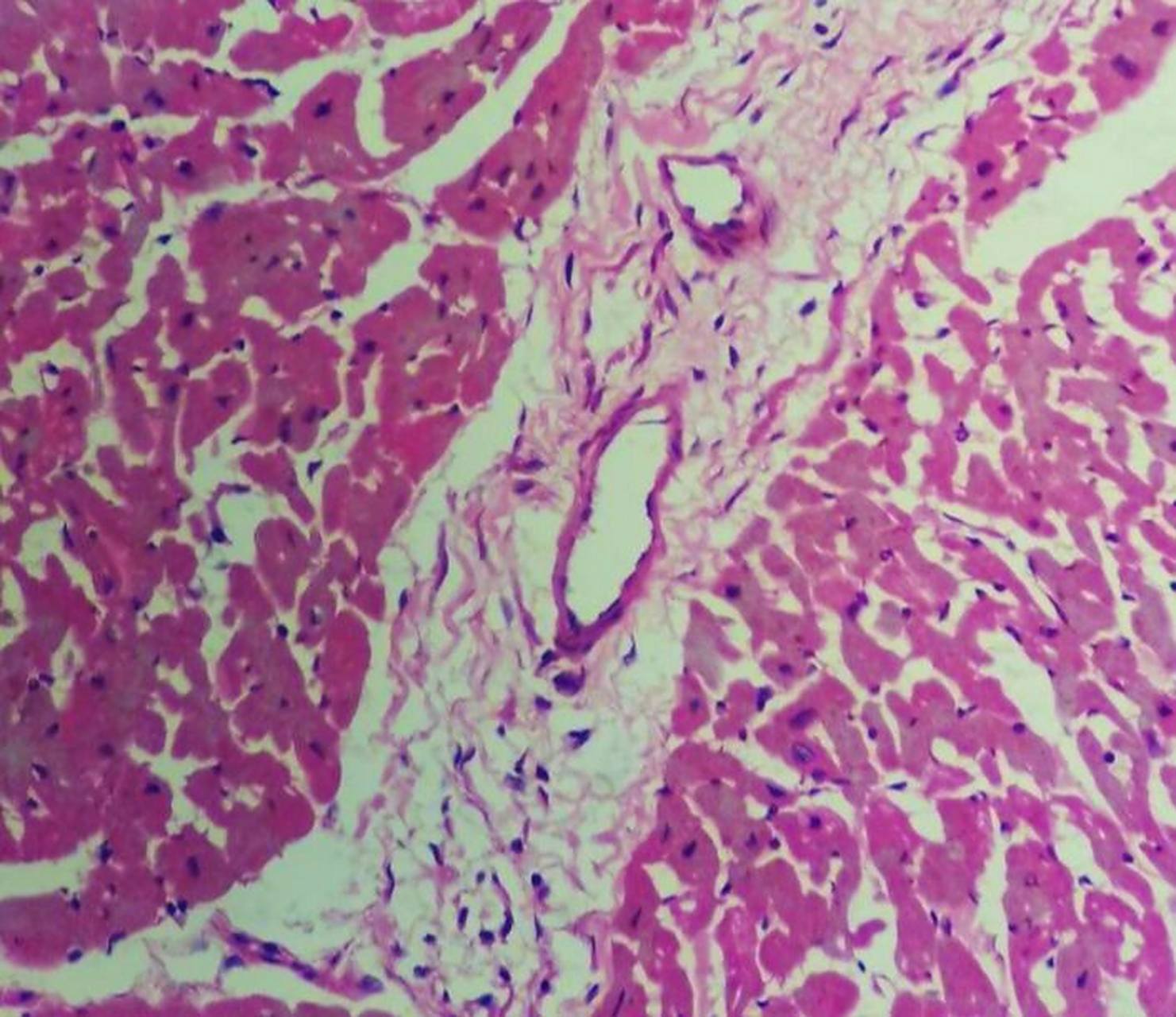 病理红蓝铅笔绘图:风湿性心肌炎 #医学生# #医学生笔记# #医学# #红蓝