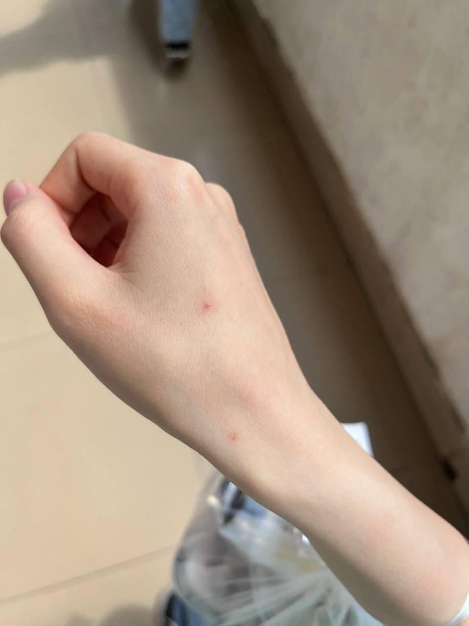 被蚊子咬的红点 被蚊子咬的红点怎么消 图二的上面那个已经几年了不会