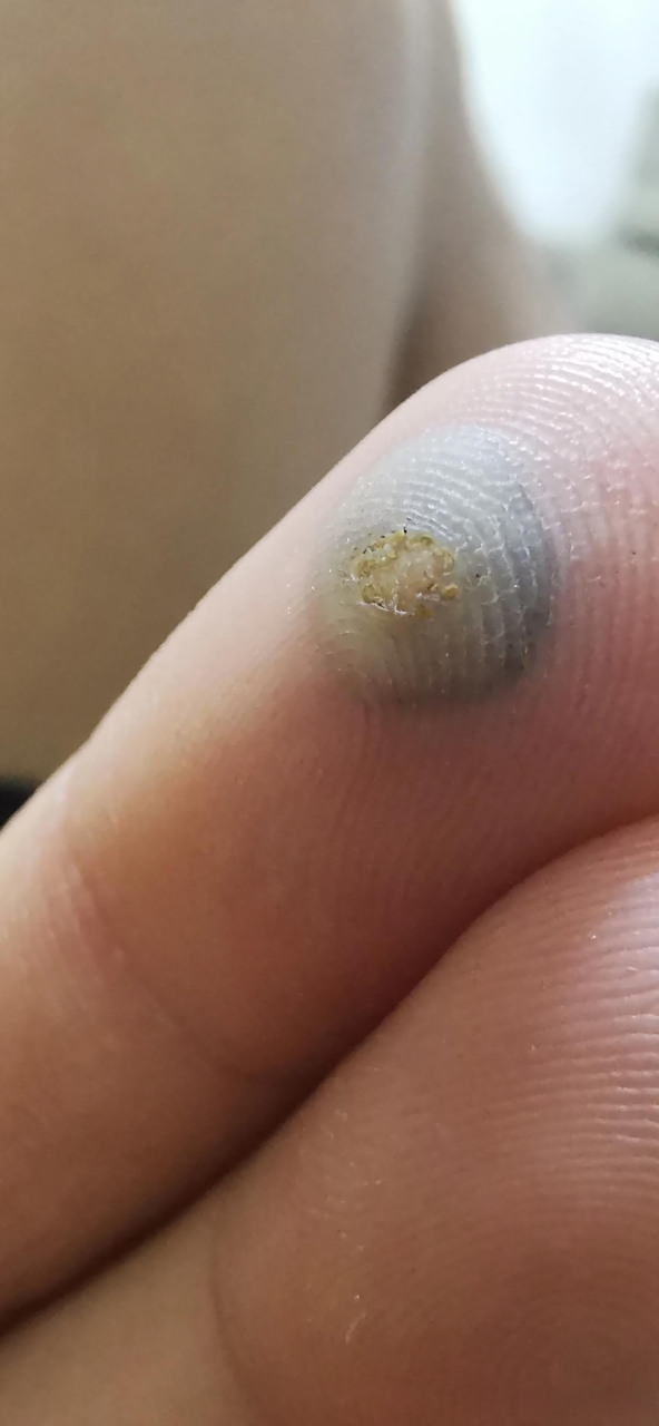 手上有跖疣,冷冻疗法究竟有没有用?