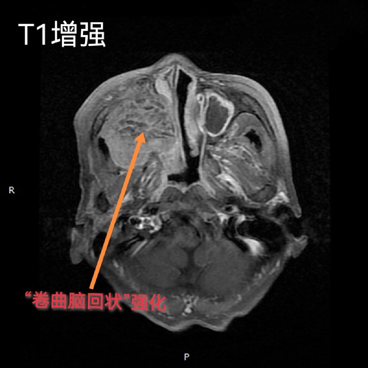 内翻性乳头状瘤