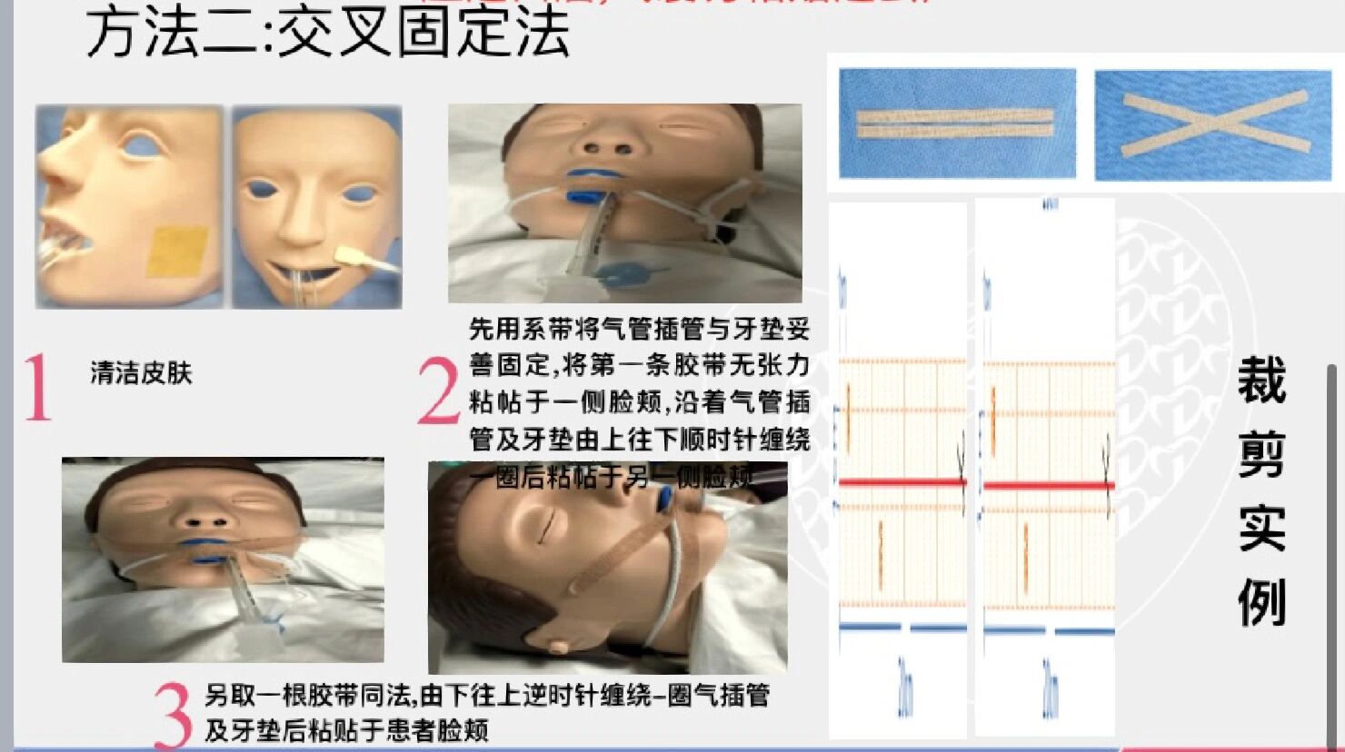 气管插管的固定方法图片