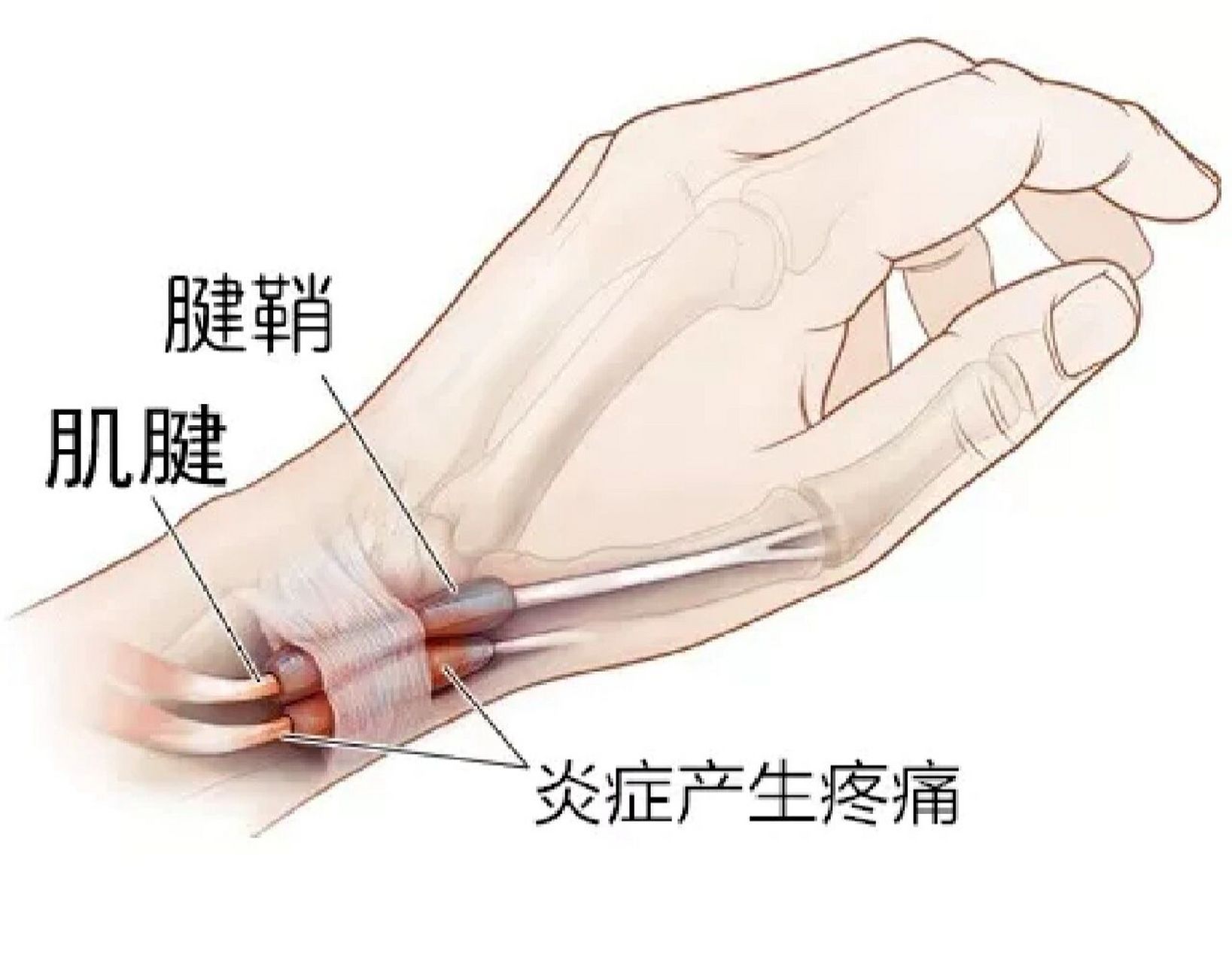 手腕腱鞘炎位置图片