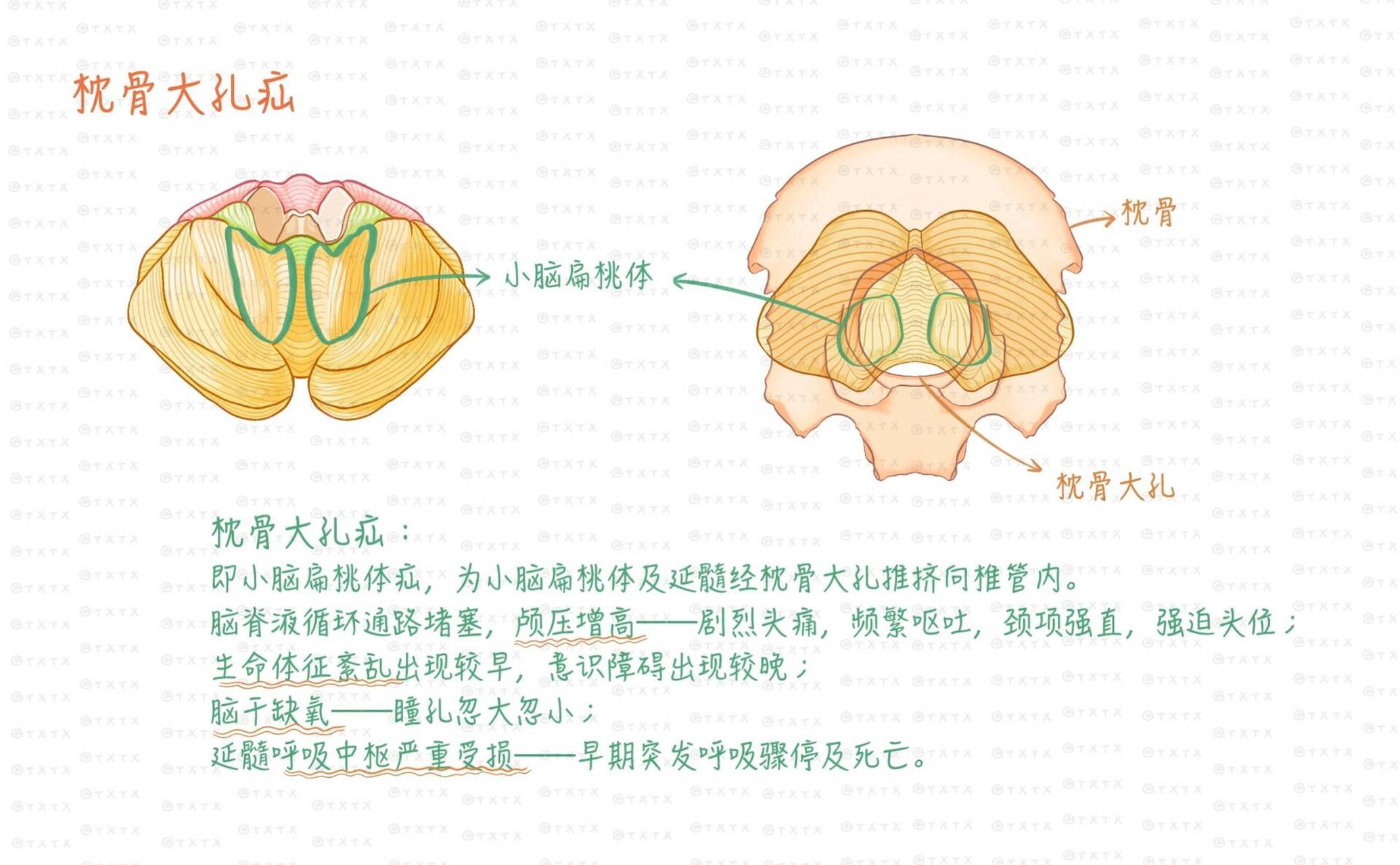 枕骨大孔疝图片