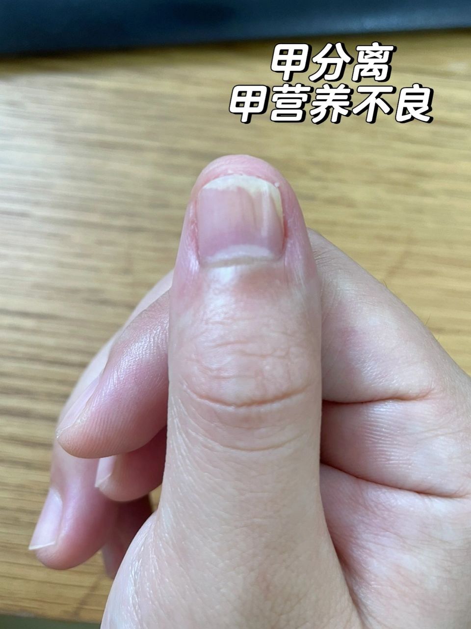 甲营养不良,检查完毕05 甲肉分离快一个月,发上来大家有说灰指甲的