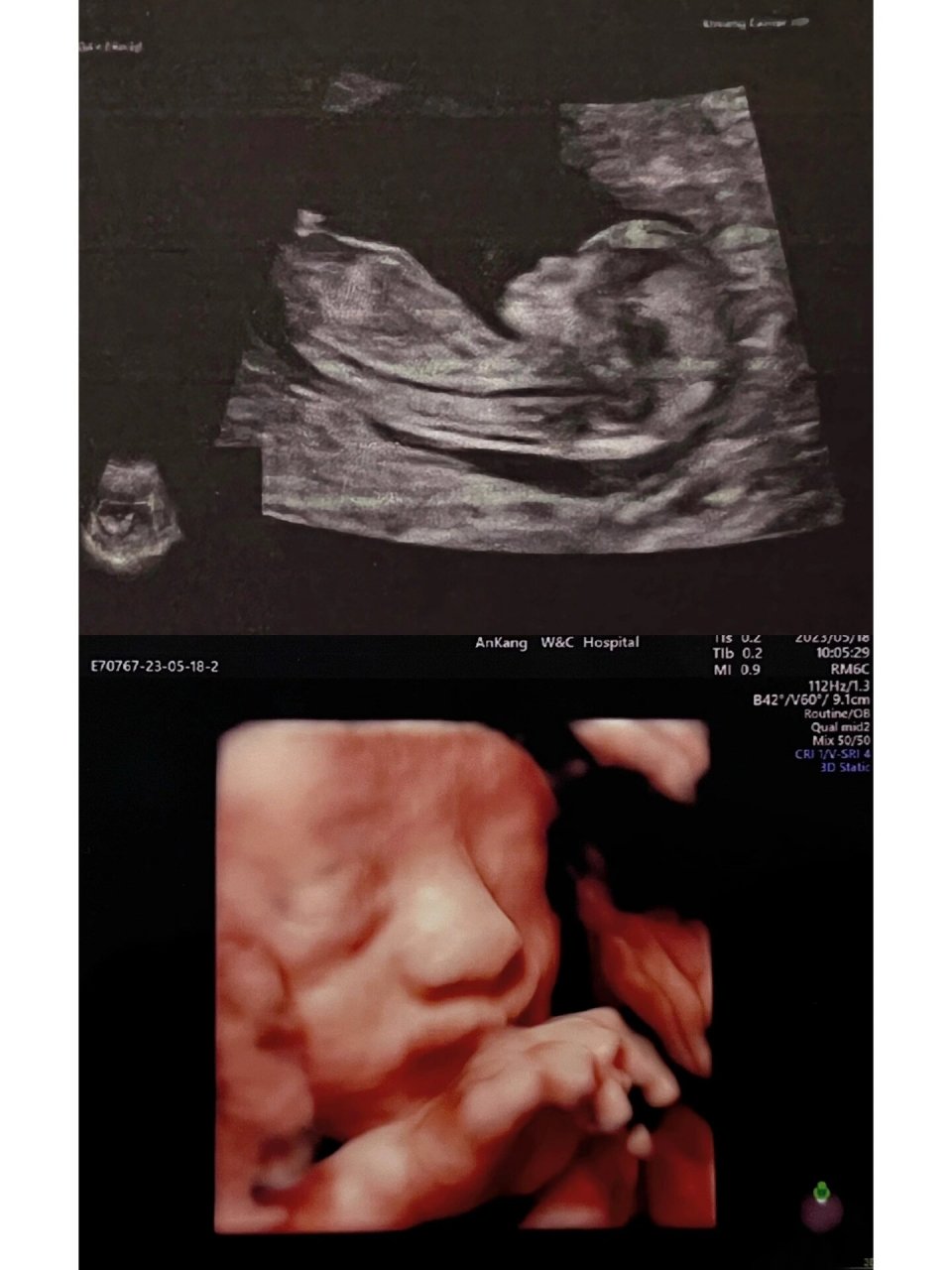 看看你们的四维彩超照片! 98救命为啥我女儿鼻子这么大啊啊啊啊!