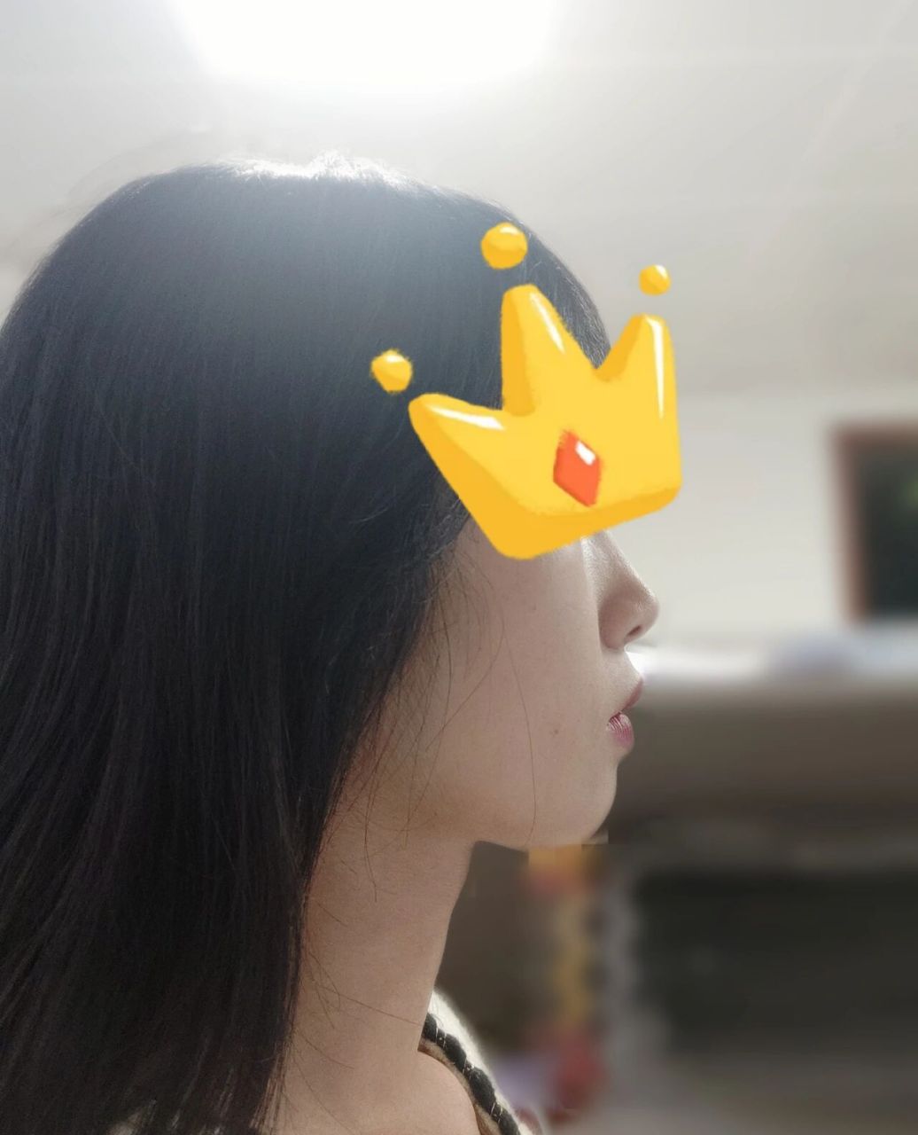 给姐妹们信心,骨性二类正畸效果绝对不赖!