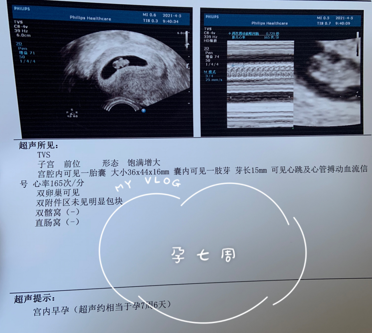 孕期记录|孕七周,新鲜出炉的胎心胎芽 怀孕第七周 第一次做b超 热乎乎