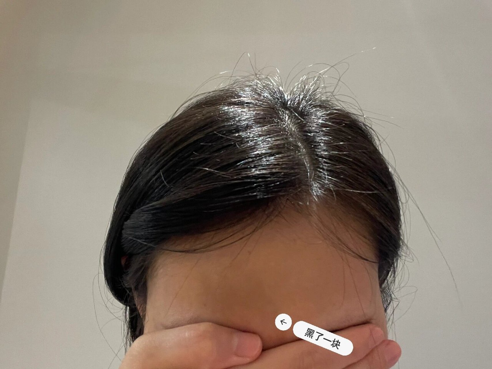 额头莫名其妙黑了一块 家人们救救我,额头黑了一块,好几个月了一直没