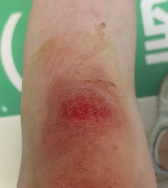 右膝关节外侧半月板前角撕裂是什么原因?