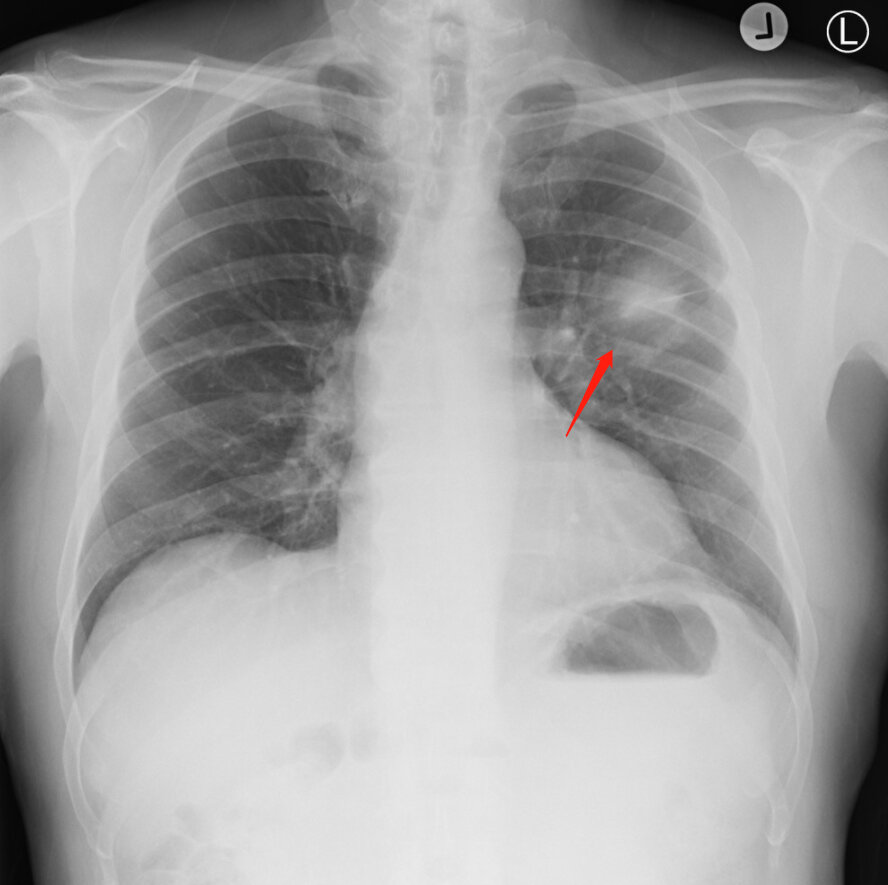 肺癌x光片图片早期图片
