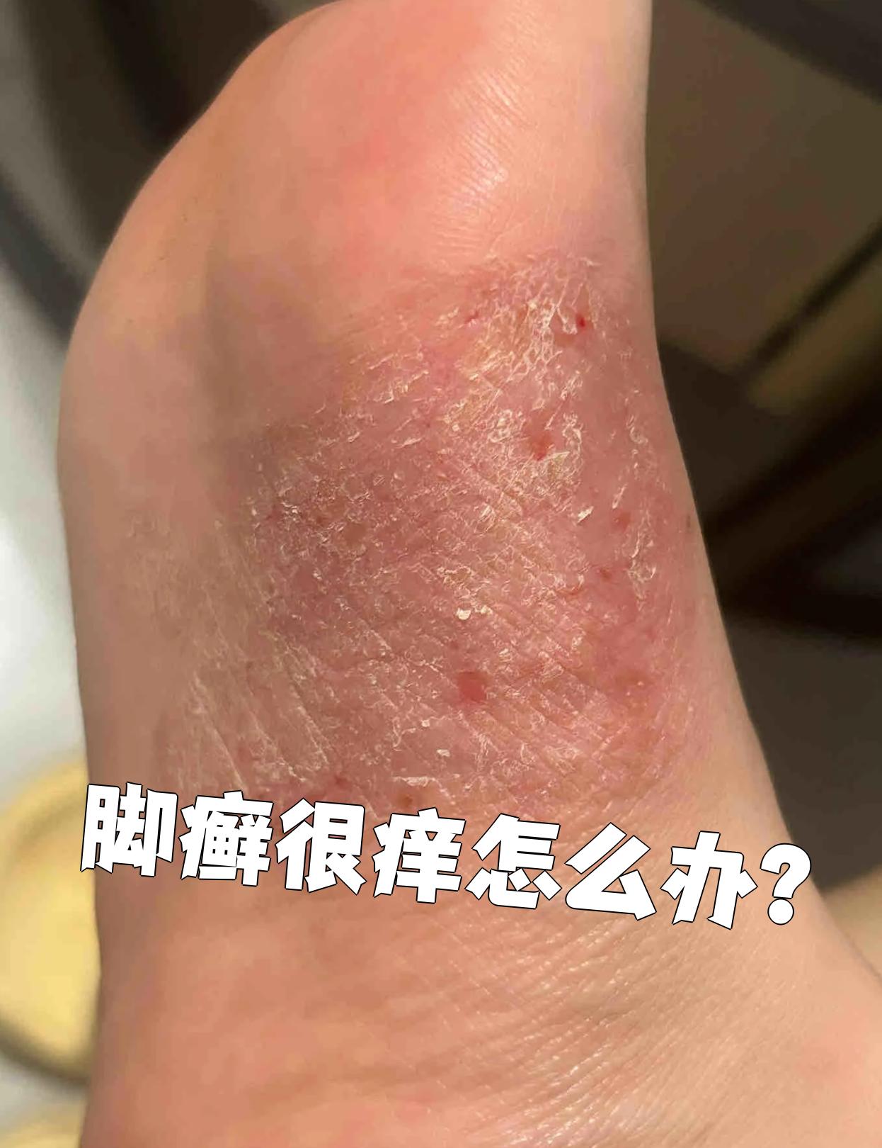 脚痒得厉害可能是足癣引起的,试试这些方法能帮你缓解症状