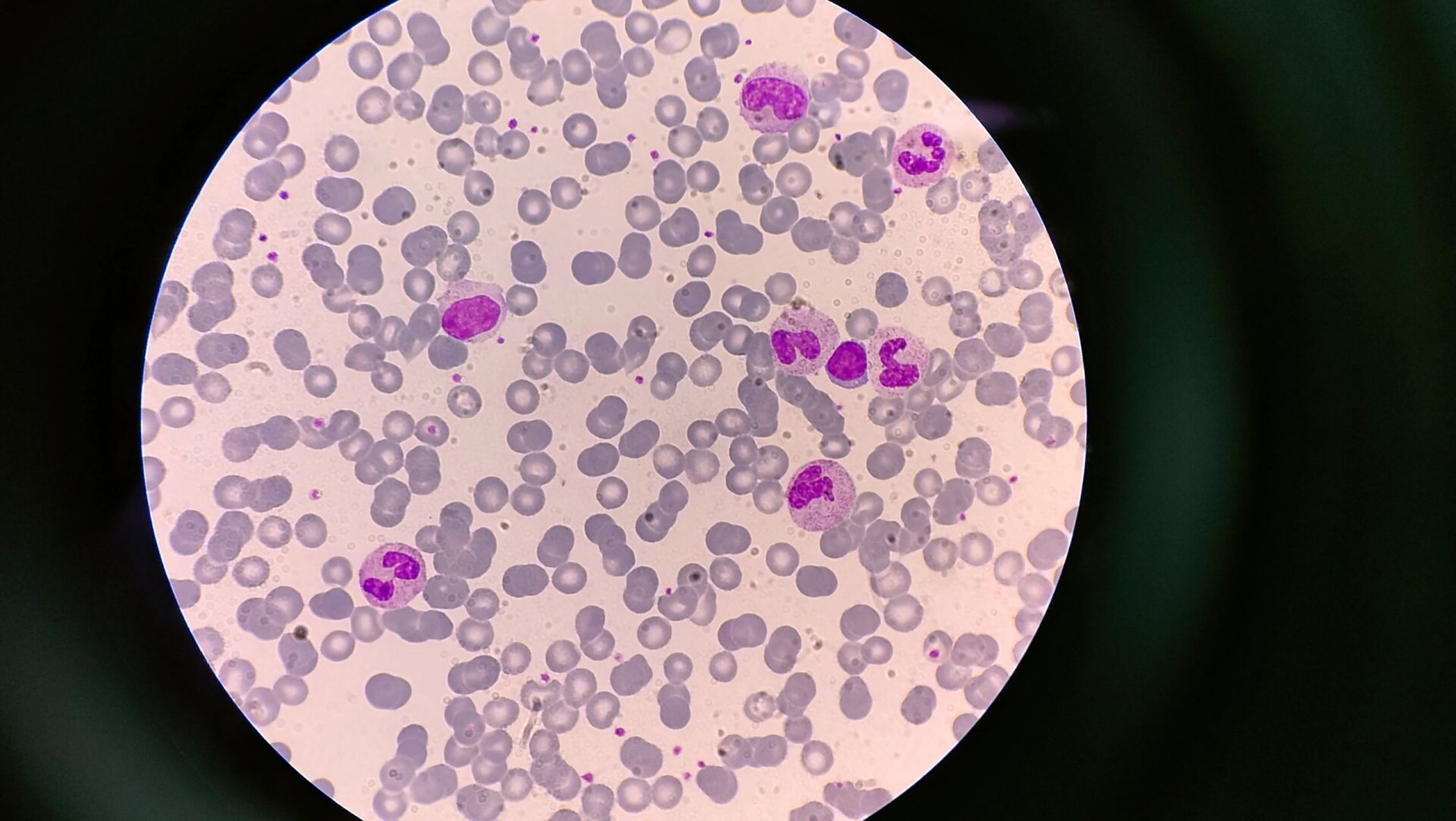 分享今日血标本 还是得多练练推血涂片