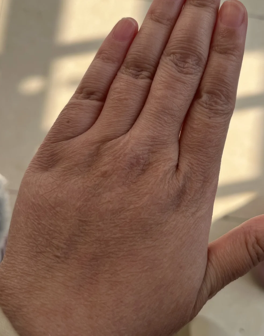 手背干燥粗糙可能是天气干燥,湿疹或接触性皮炎引起的,下面具体说说