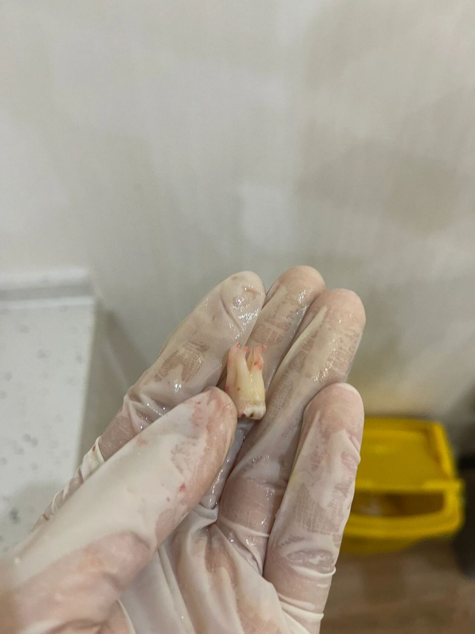 拔智齿过程中会打麻药,拔牙过程中不会感觉到疼痛,但是可能会感觉到