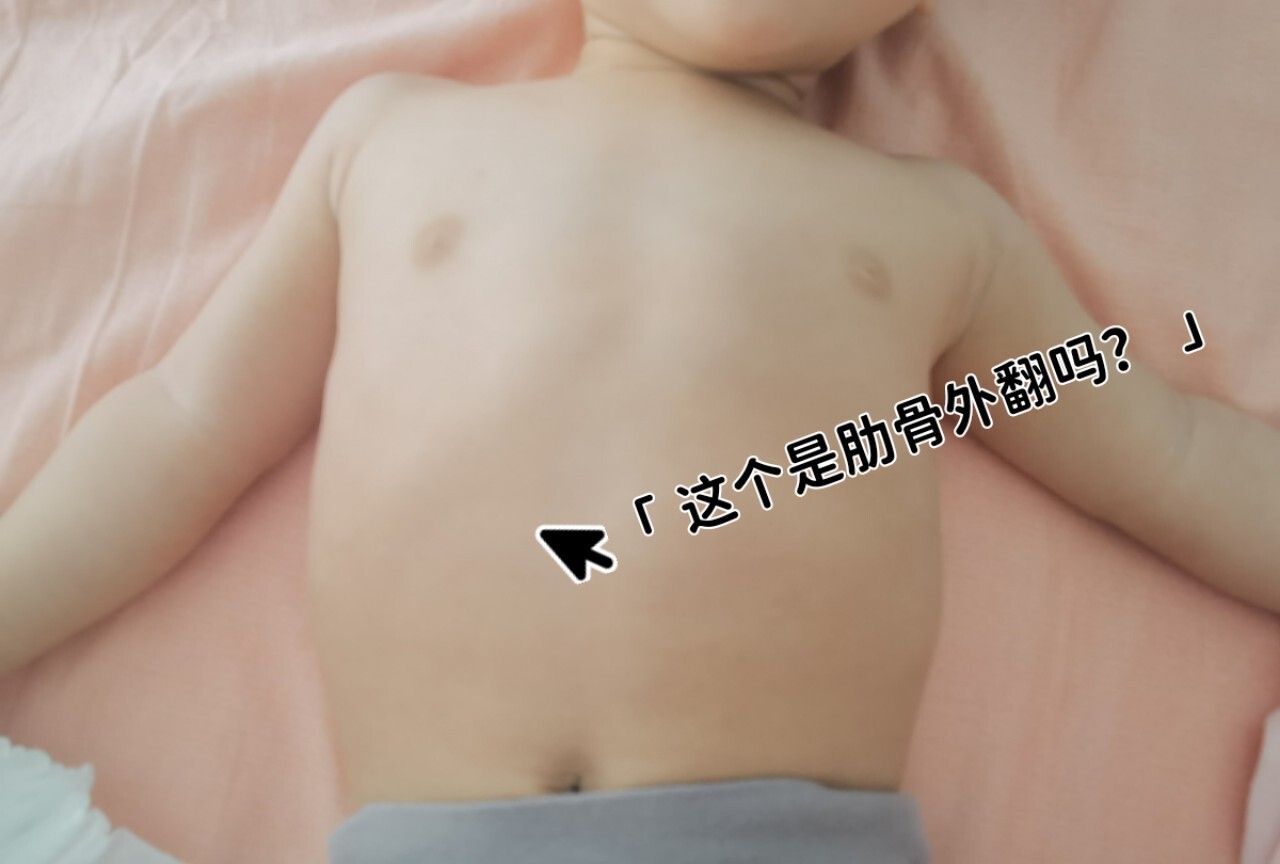 请问这是肋骨外翻吗?