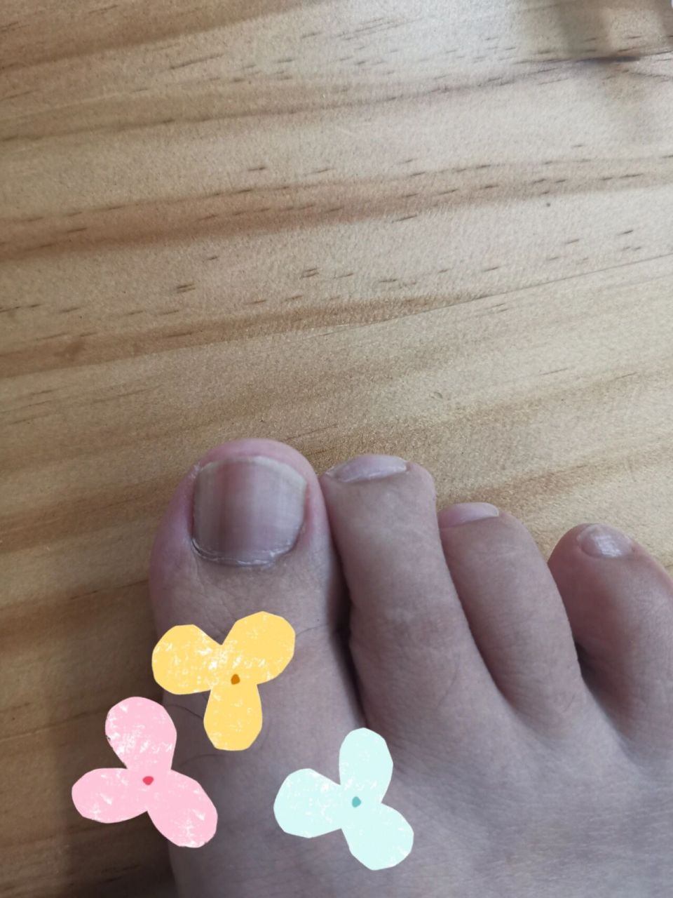 甲母痣切除手术94    	 我这个黑线长了大概十年了 一开始是很细的