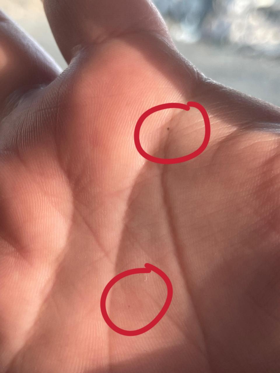 手心突然长了个痣 红色的是出血点还是朱砂痣呀有什么含义吗?