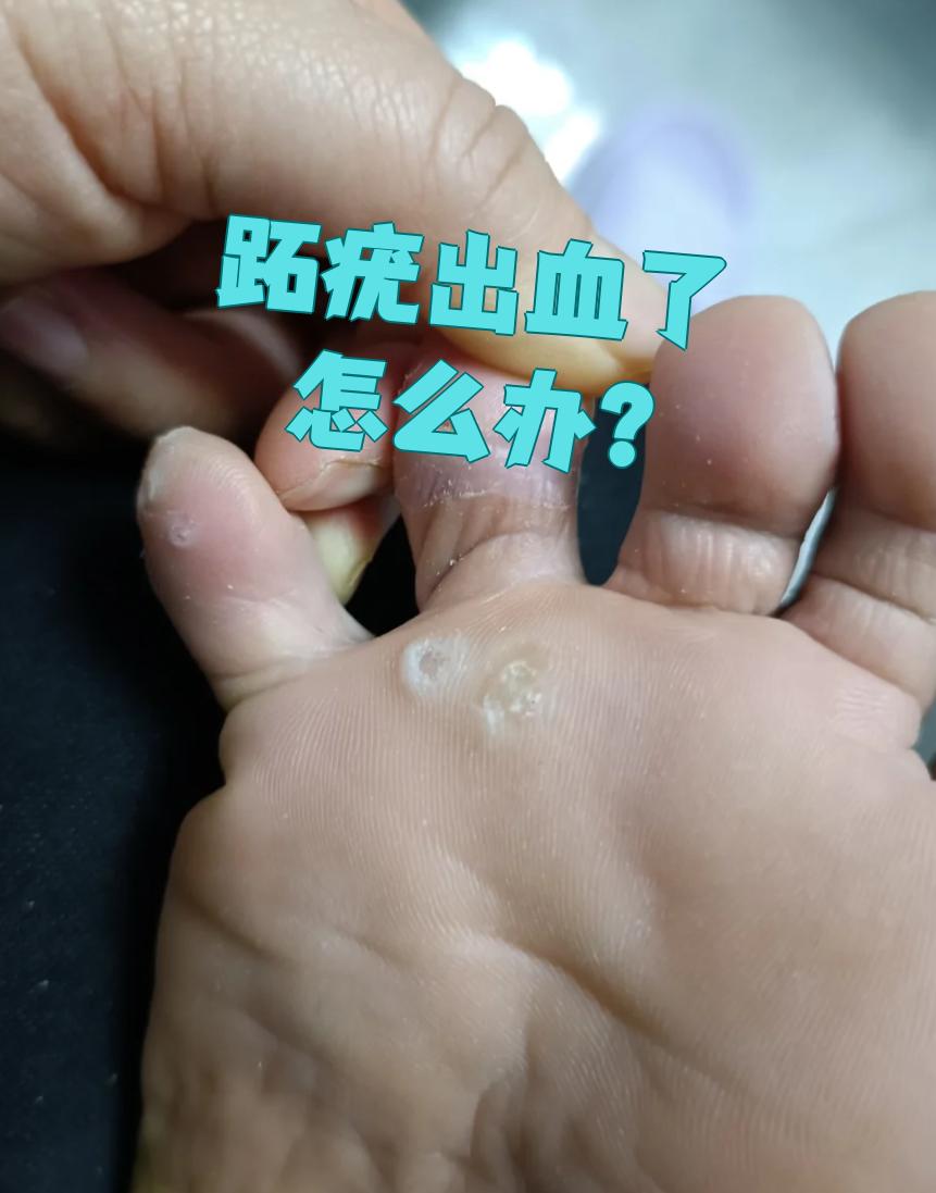 跖疣出血了要先止血,然后尽快去医院处理