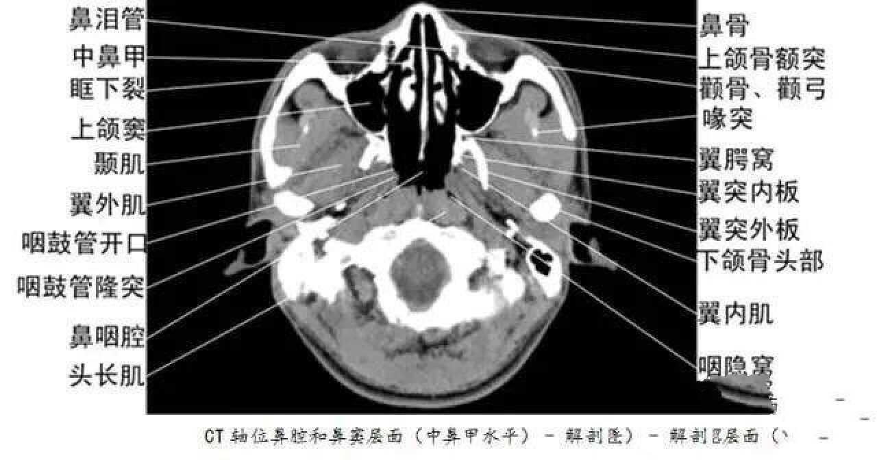 脑干ct解剖图片